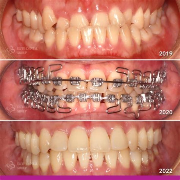Retainer To Fix Underbite Retainer To Fix Underbite