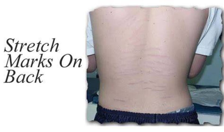 Stretch marks on back - How To Discuss